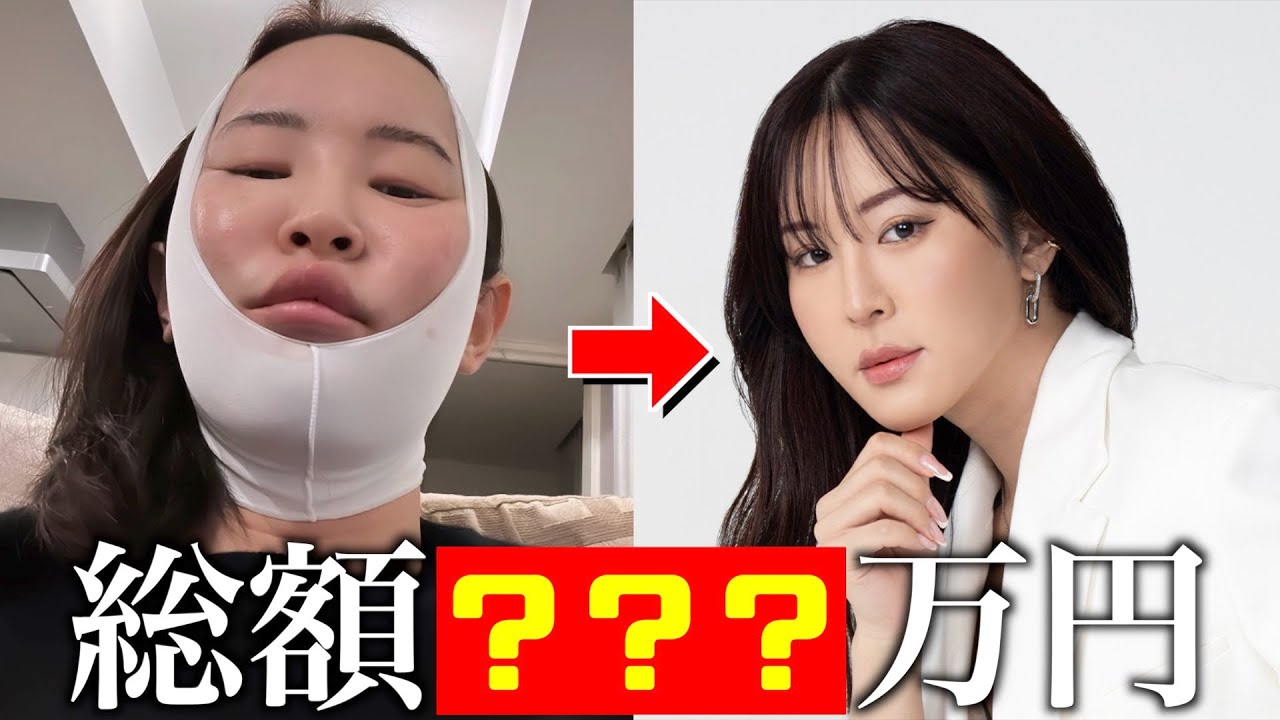 【顔面課金】花上惇の今まで受けた整形について全て話します。