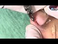 Ep_6541 Ingrown toenail removal 👣 ดูแลแบบพี่บอก..จะไม่กลับมาเป็นอีก 😄 (clip from Thailand)