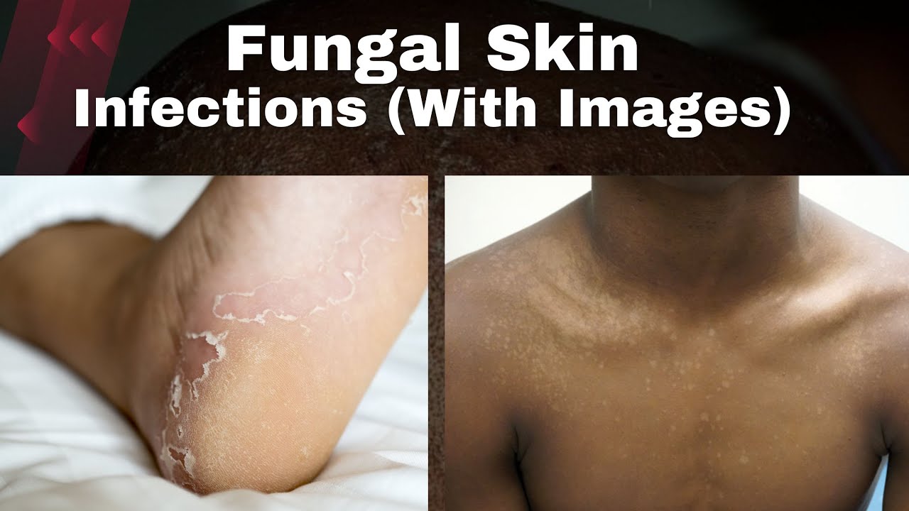 Black Skin Fungal Skin