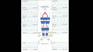 Bilateral Lower Extremity Pressures and Waveforms - Case Study