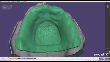 ExoCad Partial Island type Design