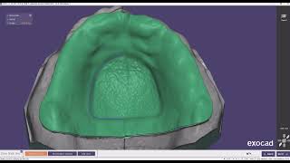 ExoCad Partial Island type Design