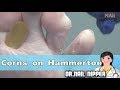 Corns on Hammertoe