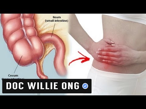 Appendicitis: Paano Maagapan - Payo ni Doc Willie Ong at Doc Liza Ong  #675b