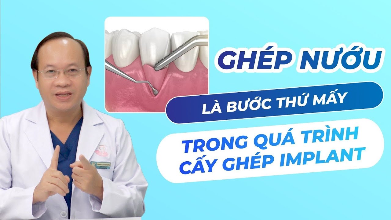 Outline Video GHÉP NƯỚU LÀ BƯỚC THỨ MẤY TRONG QUÁ TRÌNH CẤY GHÉP IMPLANT