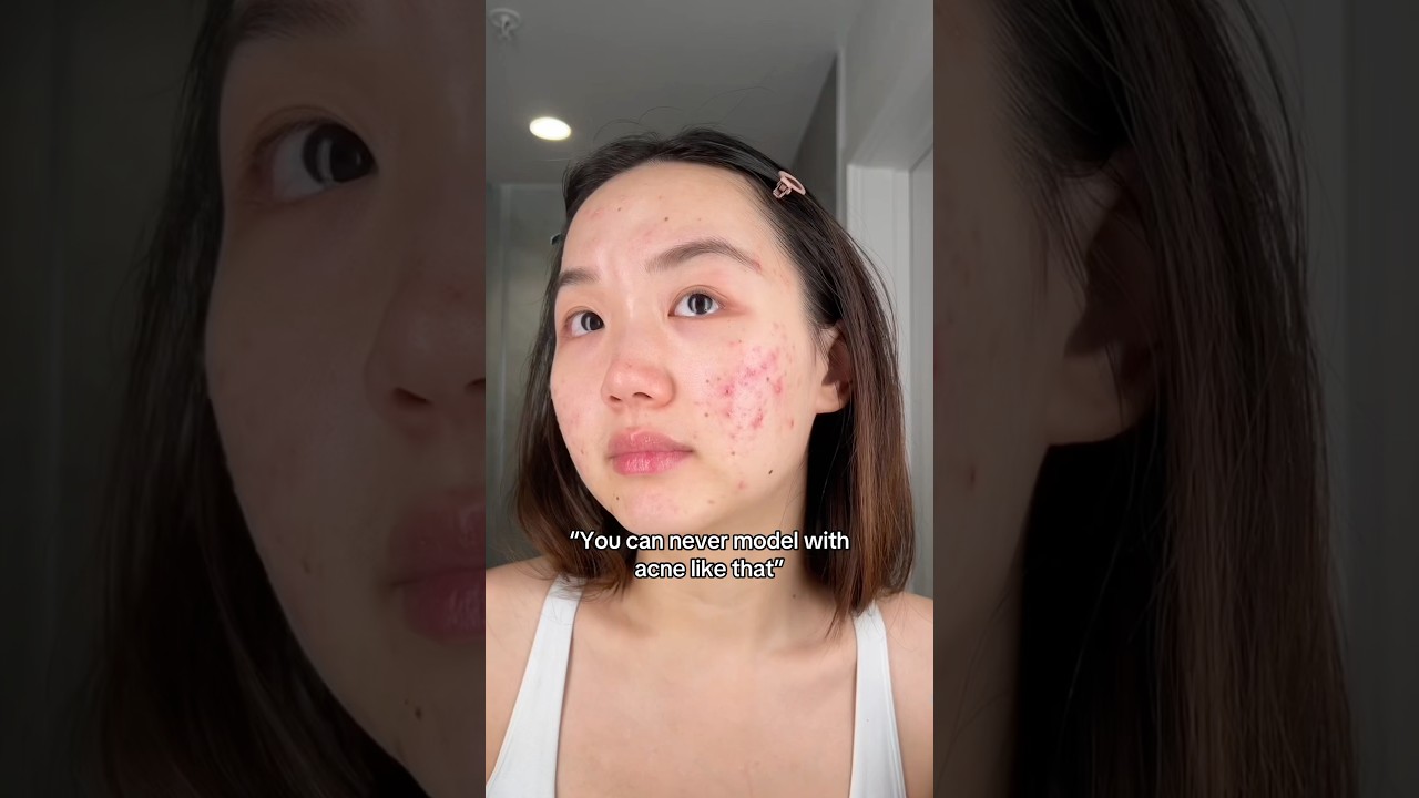 Никогда не позволяйте акне помешать вам заниматься любимым делом 🤗💖 