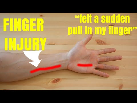 Finger injury FIXED in 4 minutes!! and WHAT IS IT? | Expert advice from Physiotherapist