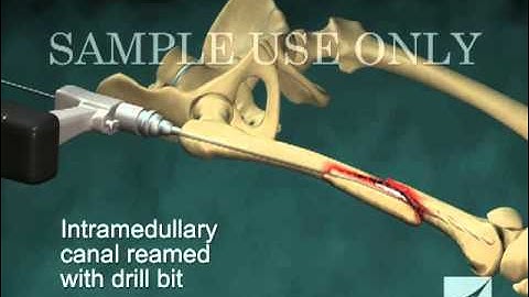Intramedullary Nailing of Right Femur Fracture