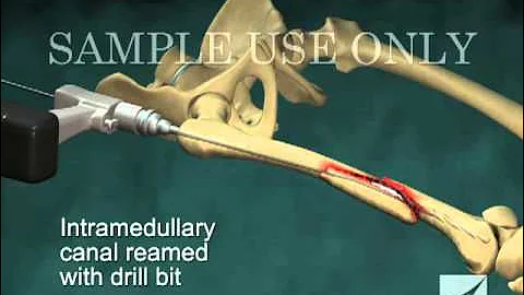 Intramedullary Nailing of Right Femur Fracture