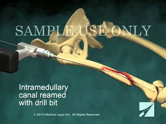 Cephalomedullary Nailing of the Proximal Femur | Musculoskeletal Key