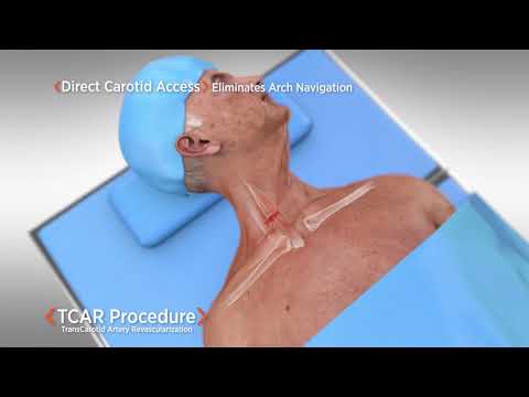Video: Unangemessene Carotis-Bildgebung, Häufig Bei Asymptomatischen Patienten