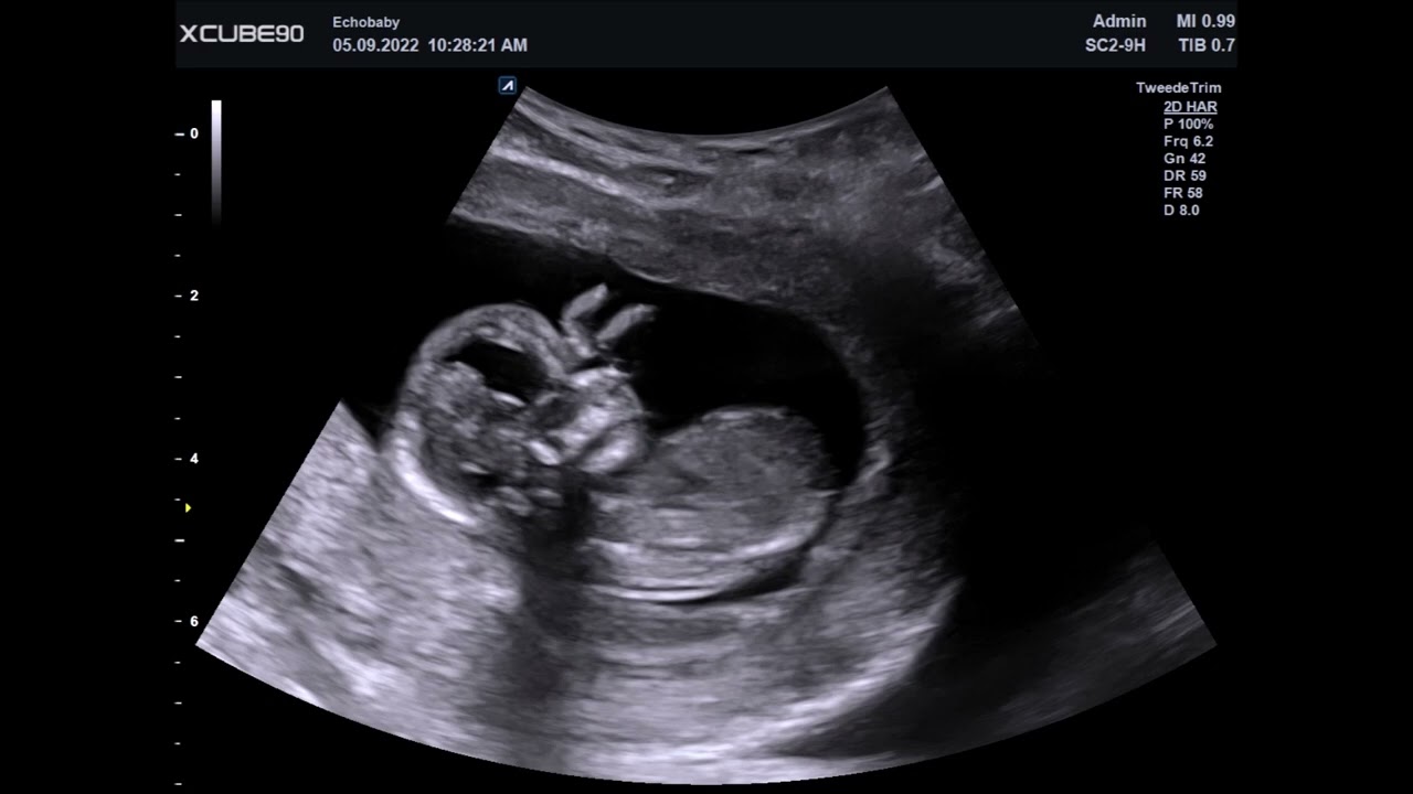 2D Echo Baby 14 Weken Zwanger