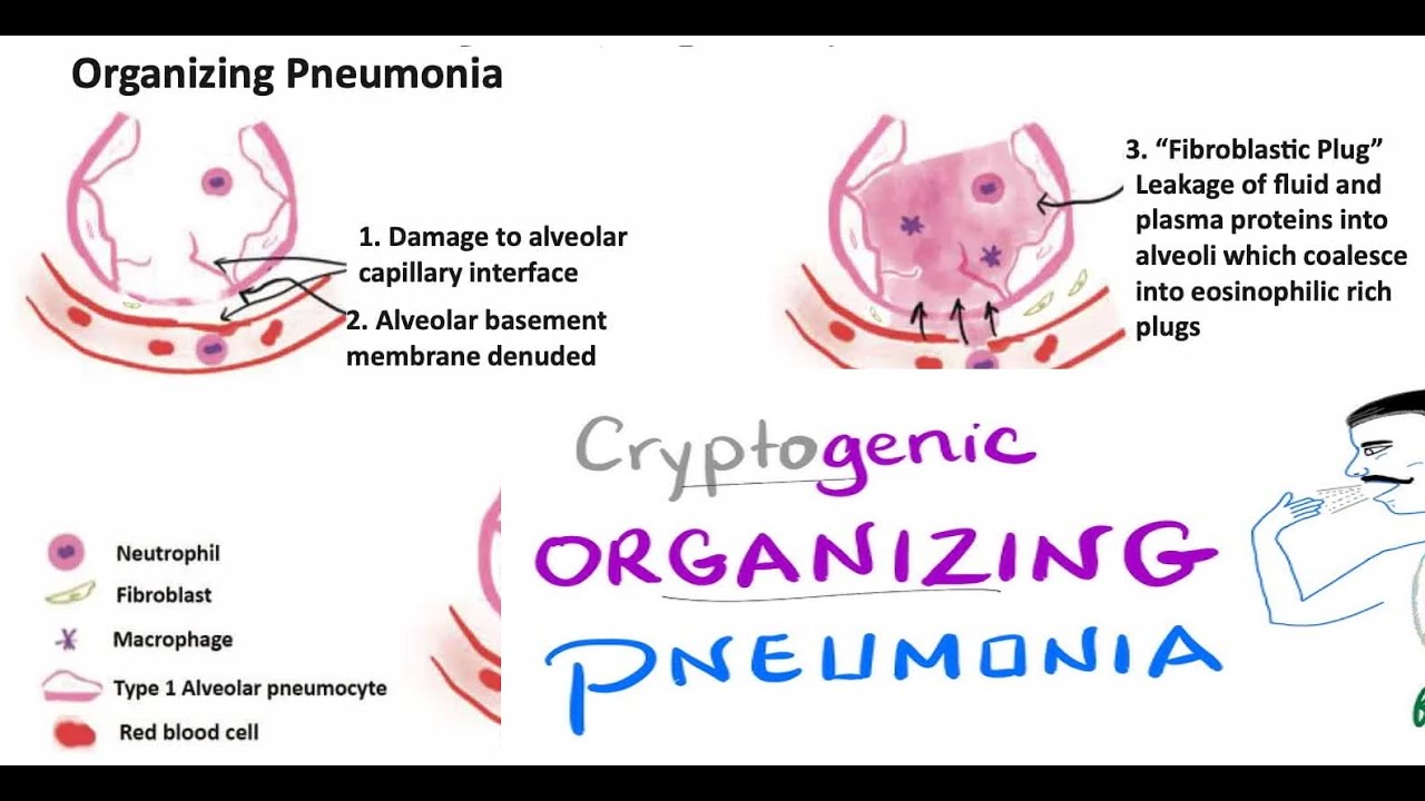 Cryptogens Cryptogenic Organizing Pneumonia - YouTube