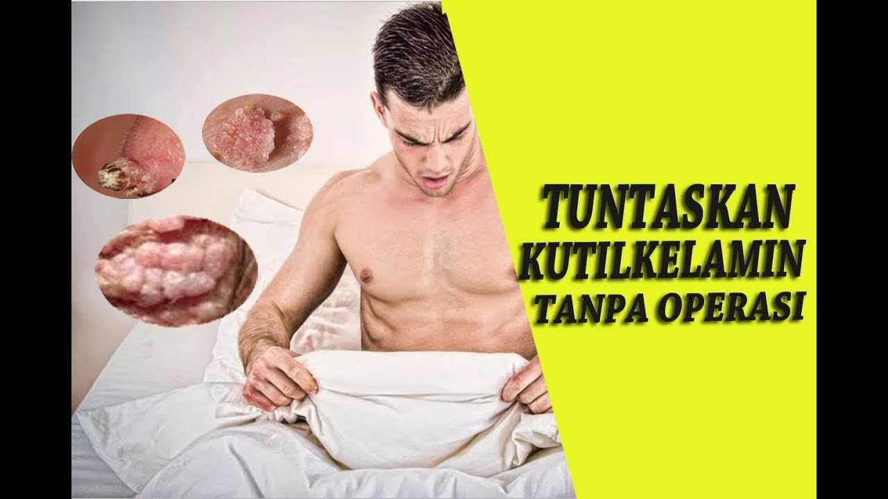 Cara Mengobati Nyeri Pada Alat Kelamin Pria Cara Mengobati Kutil Kelamin Pria Wanita Cepat Aman Tanpa Operasi - YouTube
