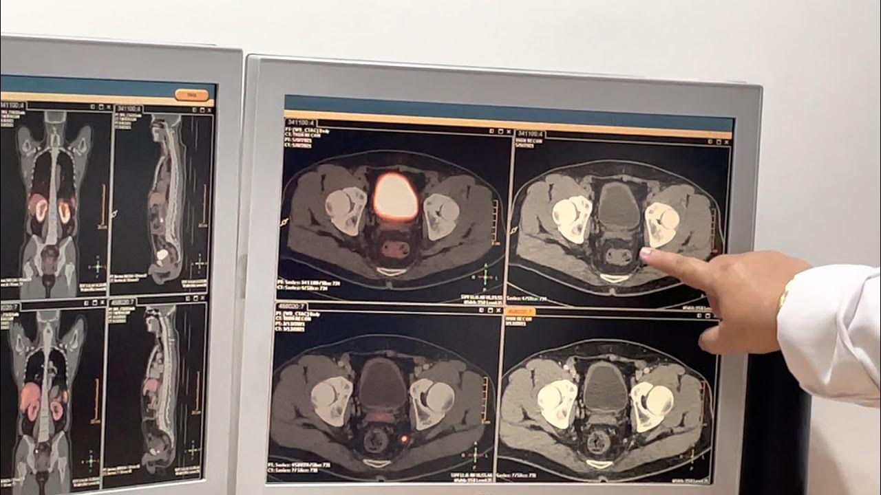 video-1-psma-pet-scan-results-after-my-lutetium-177-lu177-prostate