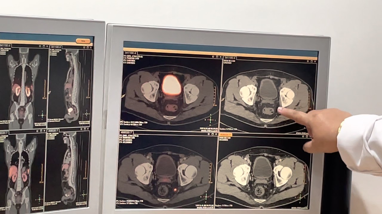 Video 1 PSMA PET Scan Results After My Lutetium 177 LU177 Prostate Video 1 PSMA PET Scan Results After My Lutetium 177 LU177 Prostate