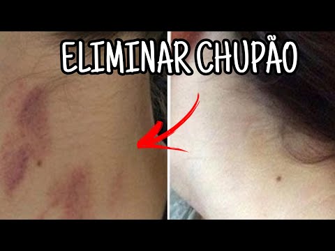 Vídeo: Como se livrar de um chupão rápido: 9 etapas (com fotos)