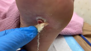 Ketuat Viral Warts Kaki Berlubang - Drman Ttdi Live