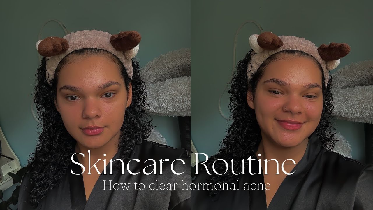 HOW I CLEARED MY *HORMONAL ACNE* | sensitive & acne prone skin skincare ...