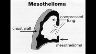 What is Malignant Mesothelioma Cancer thoughts_of_billionaire