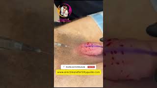PRP Injections to Improve Penis Erections| P Shot Live Demo | Non- Surgical ED Treatment