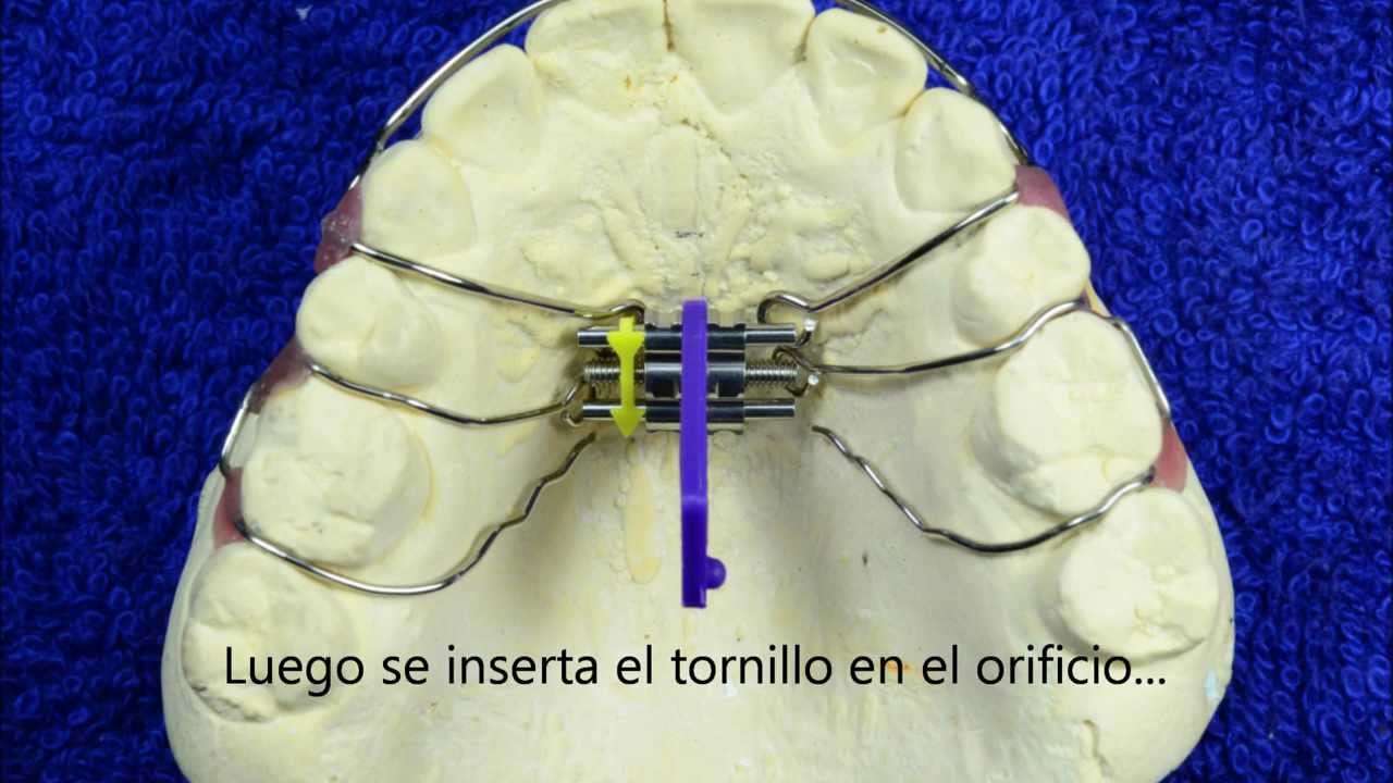 Colocación correcta del tornillo bilateral en un modelo superio HD