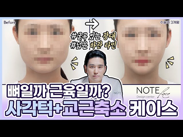 [유.케.리] 📍 CT로 보는 케이스 리뷰 l 광대 축소+핀리스 브이라인 l 교근축소