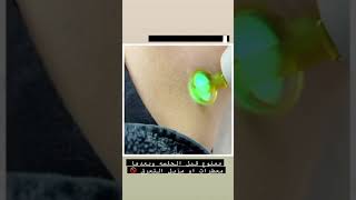 ليزر ازالة شعر under arms          جهاز جنتل لبز برو من عيادات أبا الخيل الطبي ظهرة لبن