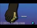 Bunion removal foot surgery preop patient education