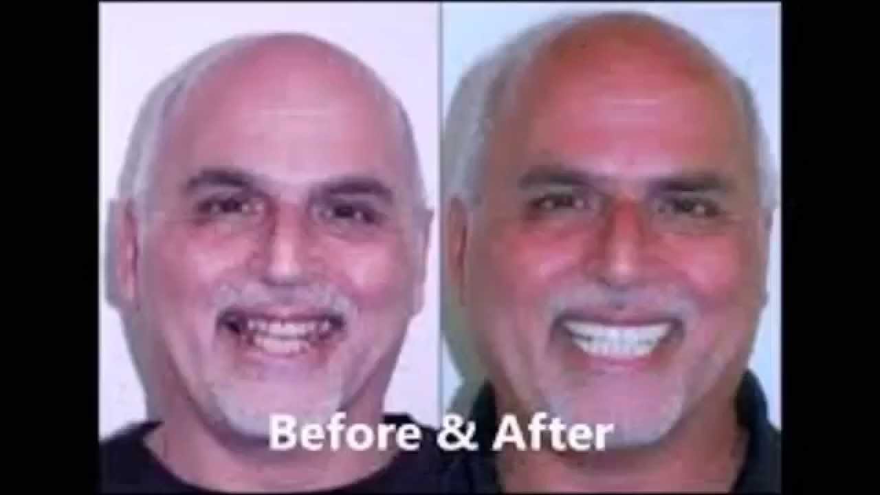 Dental Implants in Indianapolis Dental Implants in Indianapolis