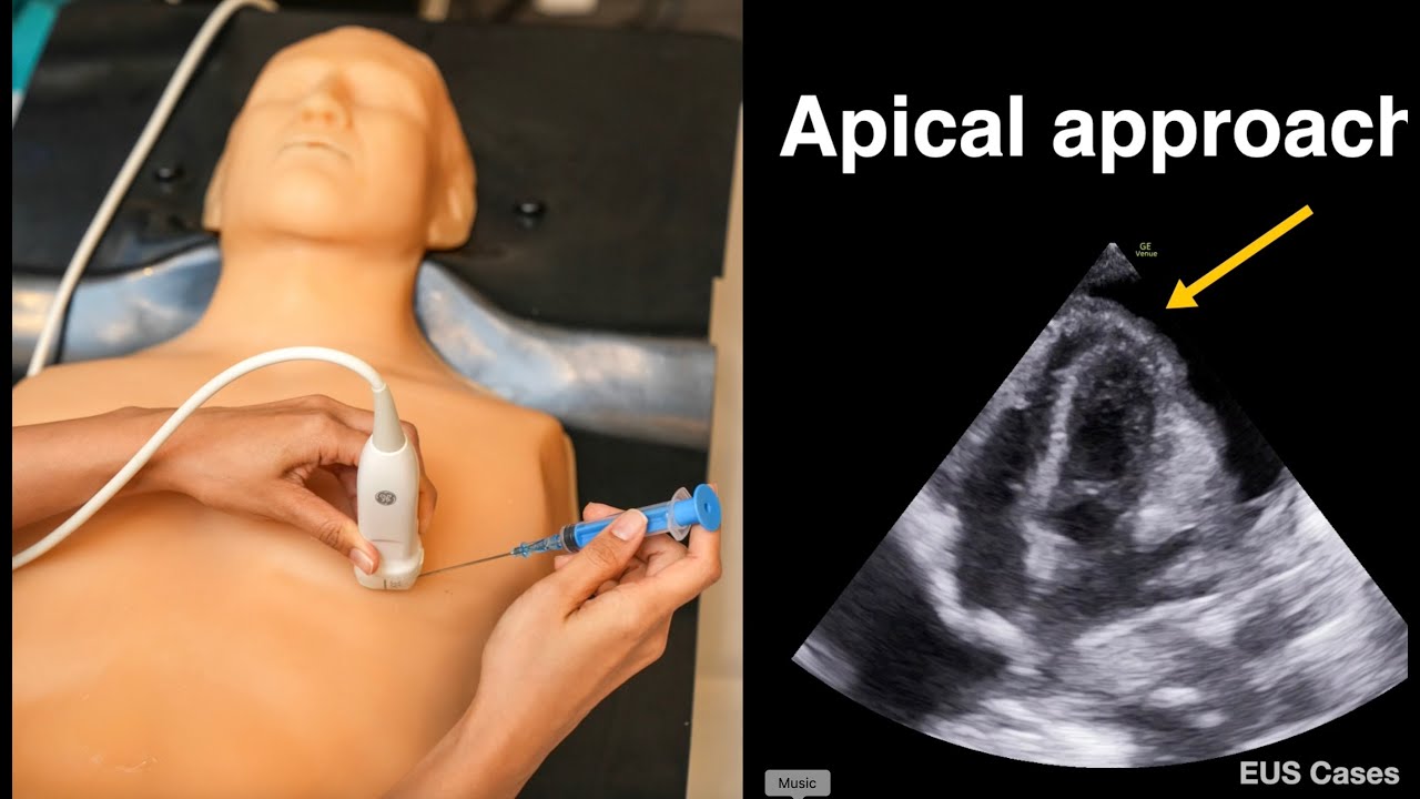 Ultrasound-guided Pericardiocentesis