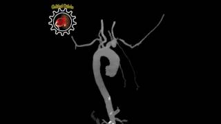 De uma temporal) cabeça artéria (arterite inflamação na