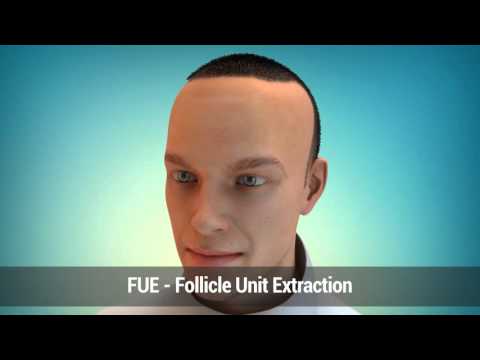 Hair Repair Clinic FUE v FUT