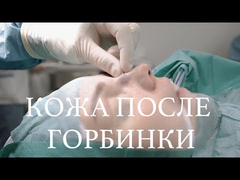 Видео: Анастасия Лисова преди и след пластична хирургия: описание на изображението и характеристиките