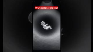 10-Weeks Ultrasound Scan | Realistic Fetus Visual at Sonogram