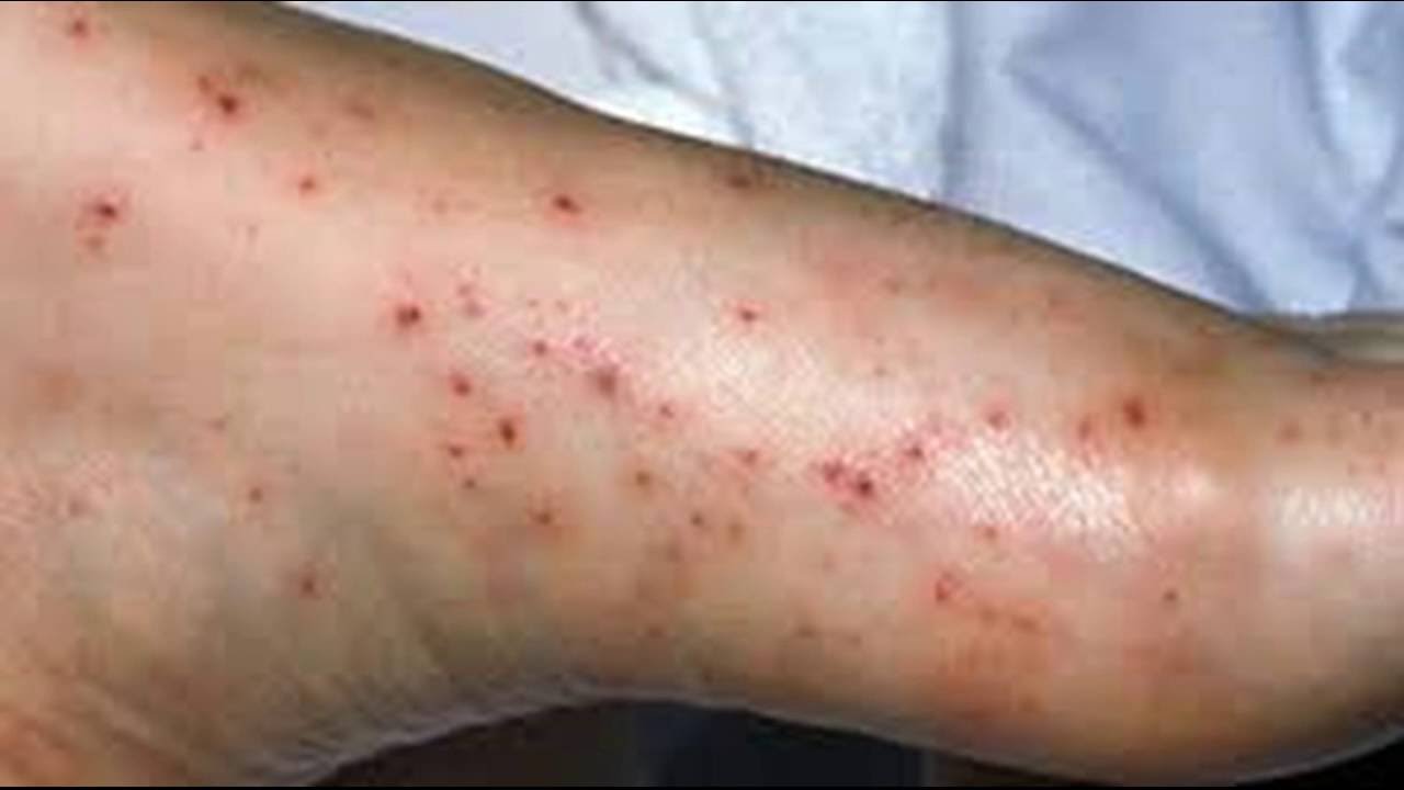 How To Treat Pinpoint Petechiae Youtube