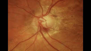 Normal (Low) Tension Glaucoma (Malik Y. Kahook, MD)