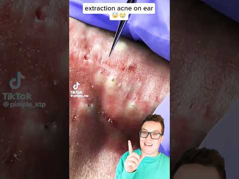 Horrific BLACKHEAD REMOVAL Fail Blackhead Removal On Ear Shorts