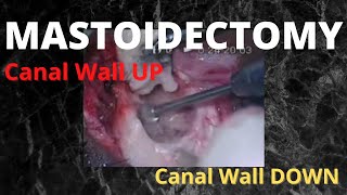 068. Canal Wall UP & Canal Wall DOWN Mastoidectomy #mastoid surgery #hearingimpaired
