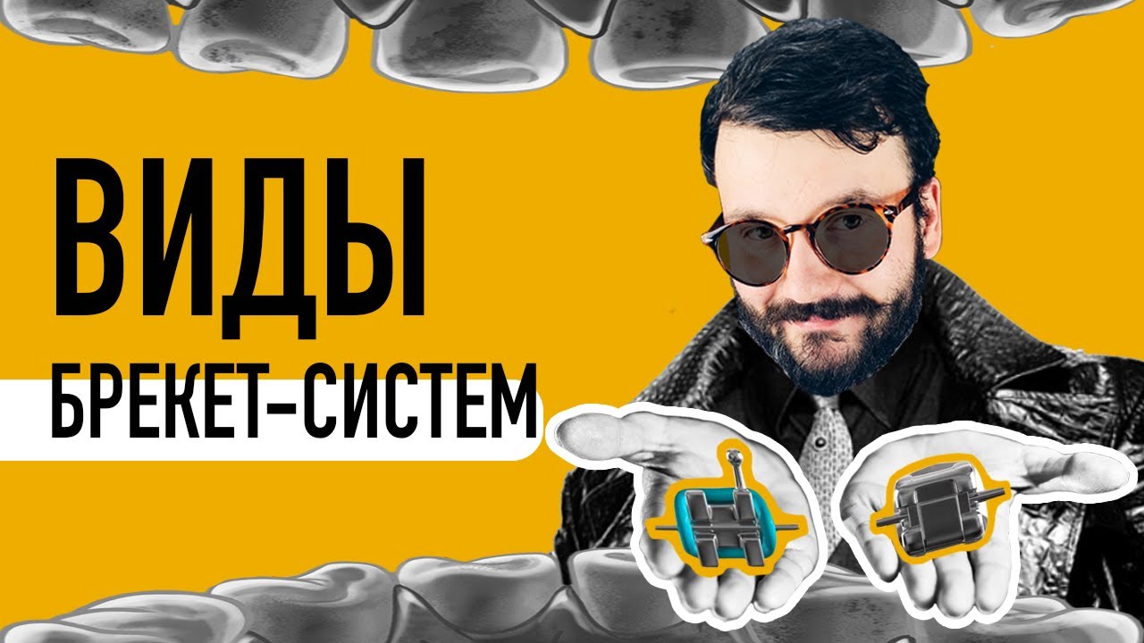 Виды брекетов. Какие брекеты лучше ставить? Ortodony - YouTube
