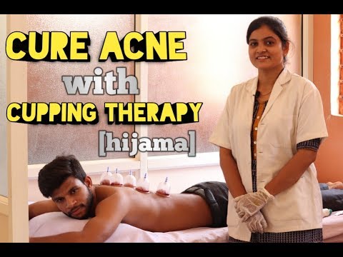 #cuppingtherapy|| #cure acne with cupping therapy (hijama)