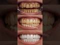 🦷 Yellow Teeth? Try This 1-Minute Whitening Hack! ✨Bright smile in minutes 😁 Easy &amp; fresh! #ytshorts
