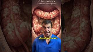 Diarrea, Colitis y Antibióticos: infección por Clostridium difficile