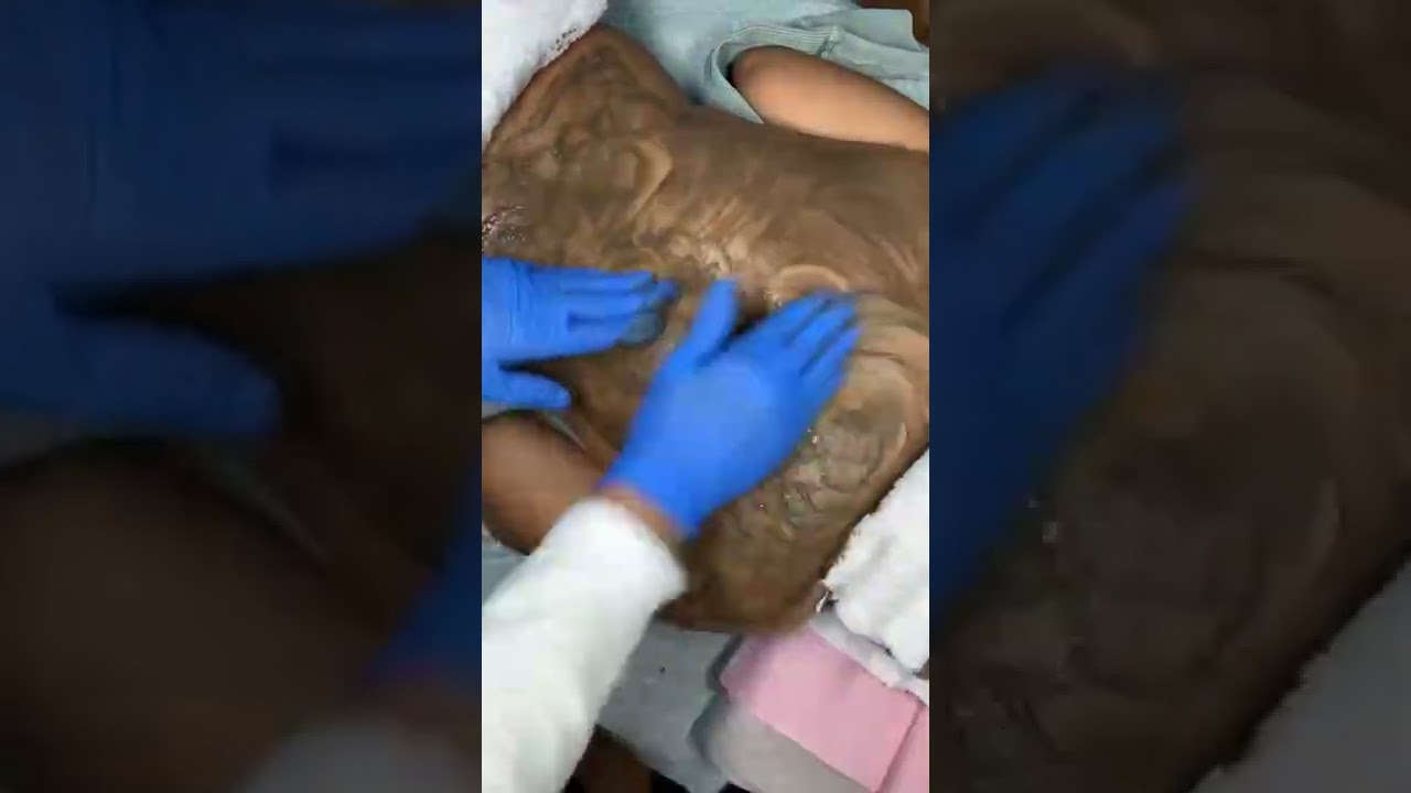 ZENA Algae Peeling Treatment | Lightening Pigmentation on Back