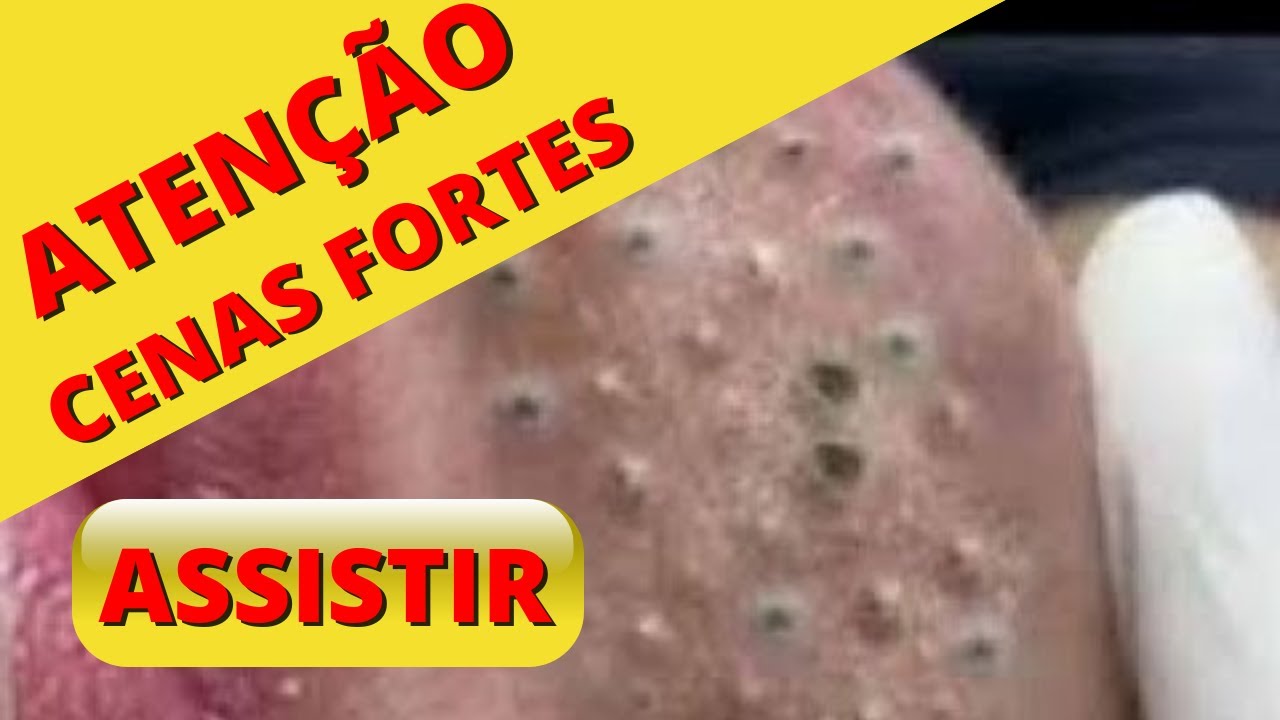 Vídeo Incrível, Espinha Gigante, Espremendo espinha e Cravos , Espinha ...