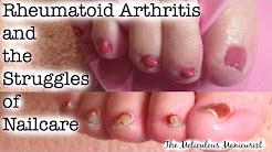 Pedicure Tutorial Rheumatoid Arthritis and the Struggles of Nail Care