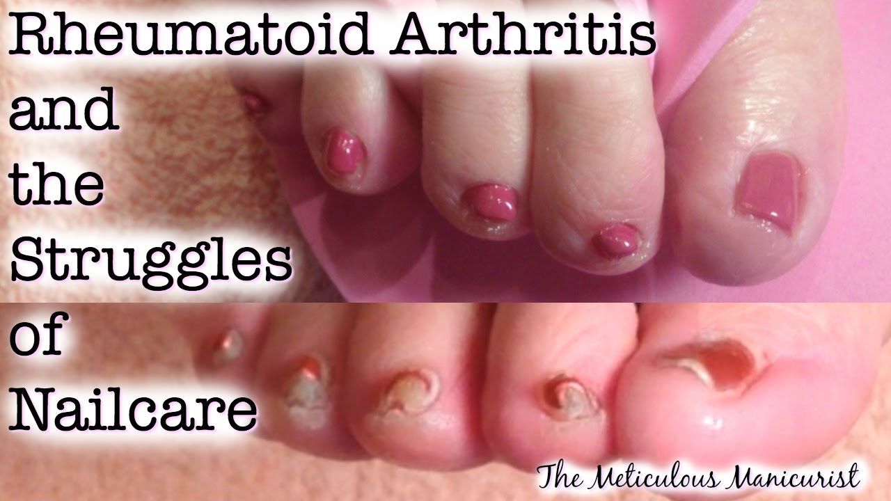 Pedicure Tutorial Rheumatoid Arthritis and the Struggles of Nail Care