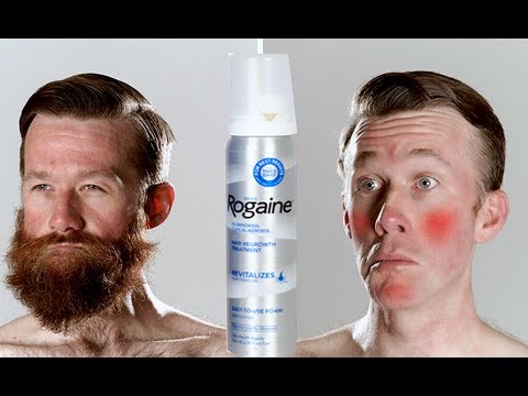 MUST WATCH! What happens when you STOP using Minoxidil! Updated week ...