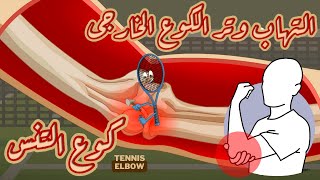 التهاب وتر الكوع الخارجي [ كوع التنس ] | أسبابه وعلاجه وكيف تتجنبه | Tennis Elbow | حلقة كاملة