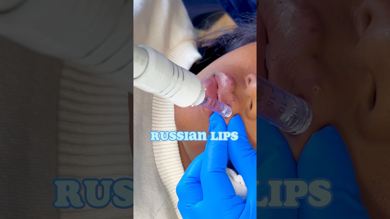 Russian Lips using the Hyaluron Pen